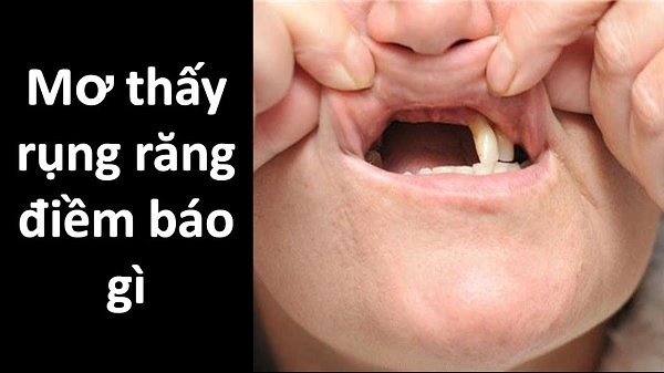 Ý nghĩa chiêm bao thấy rụng răng