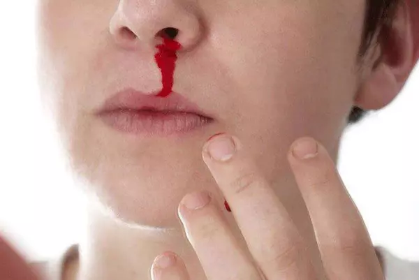 Giấc mơ thấy bị chảy máu mũi có thể tương lai sẽ có sự cãi vã